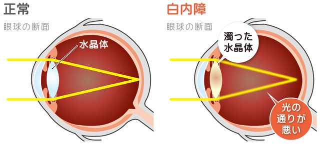 白内障ってどのような病気？