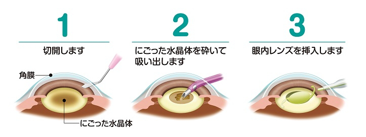 日帰り白内障手術