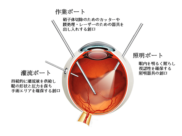 硝子体手術とは